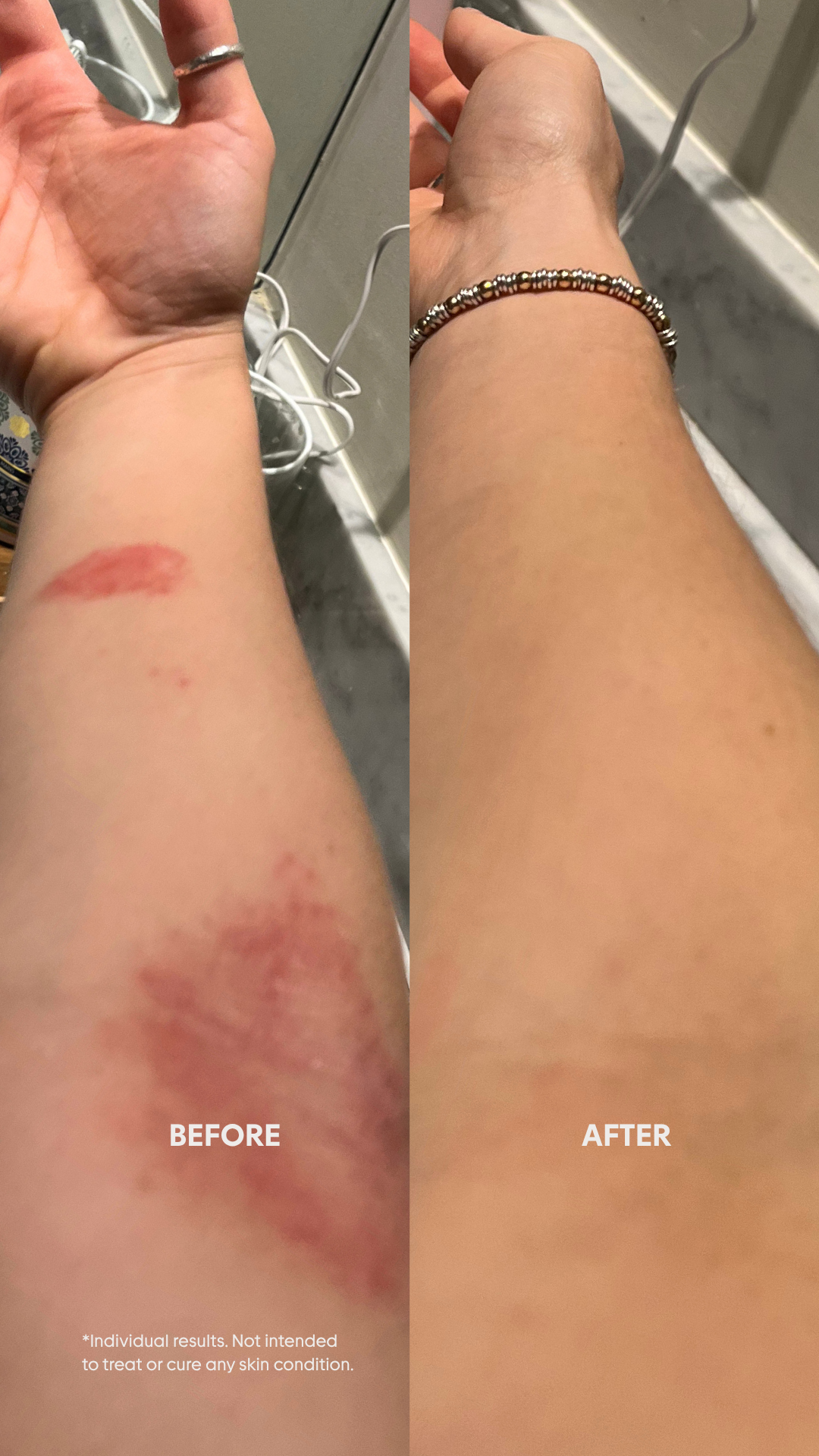 before and after of red irritated skin on arm clearing up with Irritated barrier repair serum
