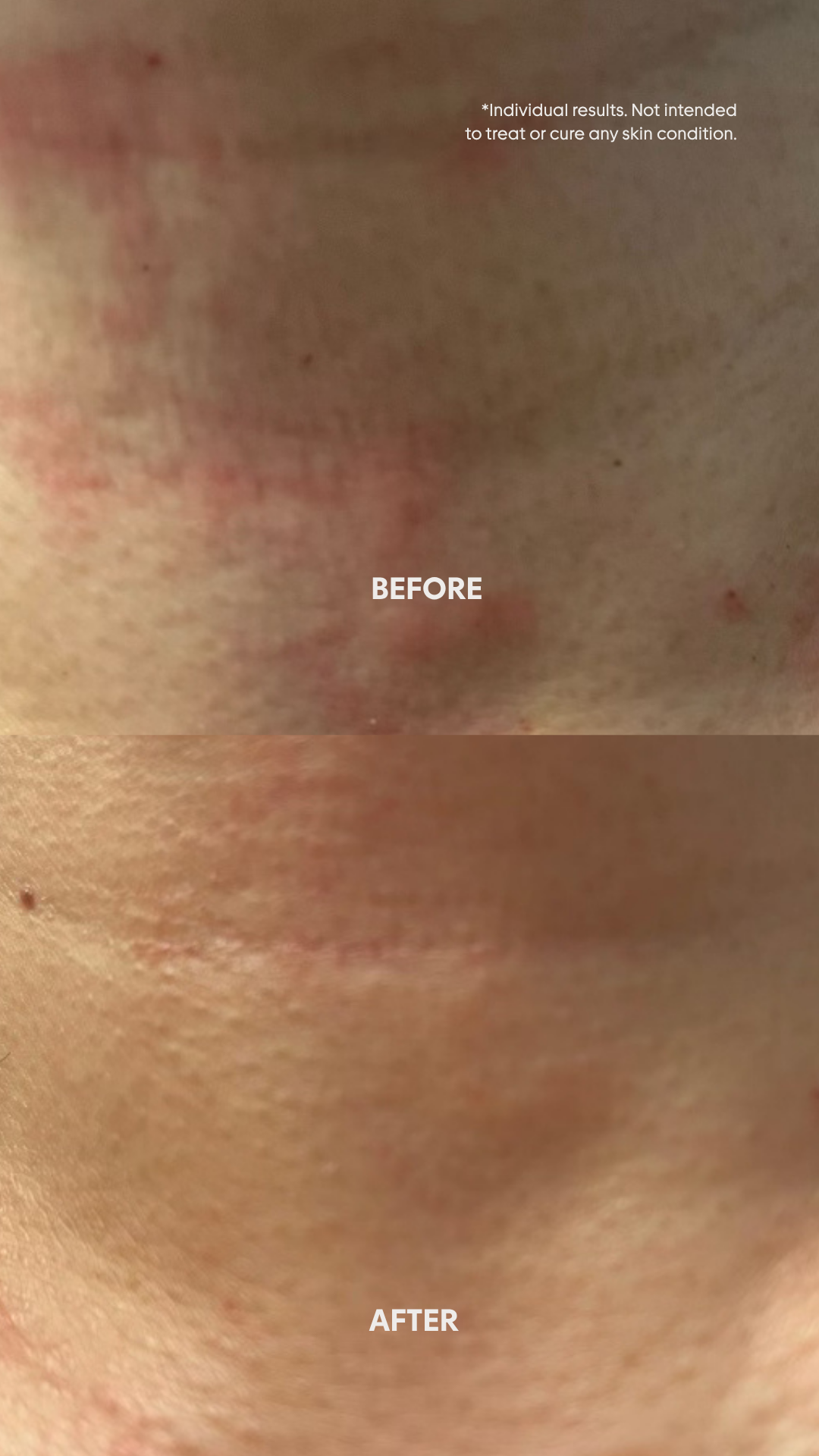 before and after red bumpy skin texture on neck improving with Irritated fragrance free serum