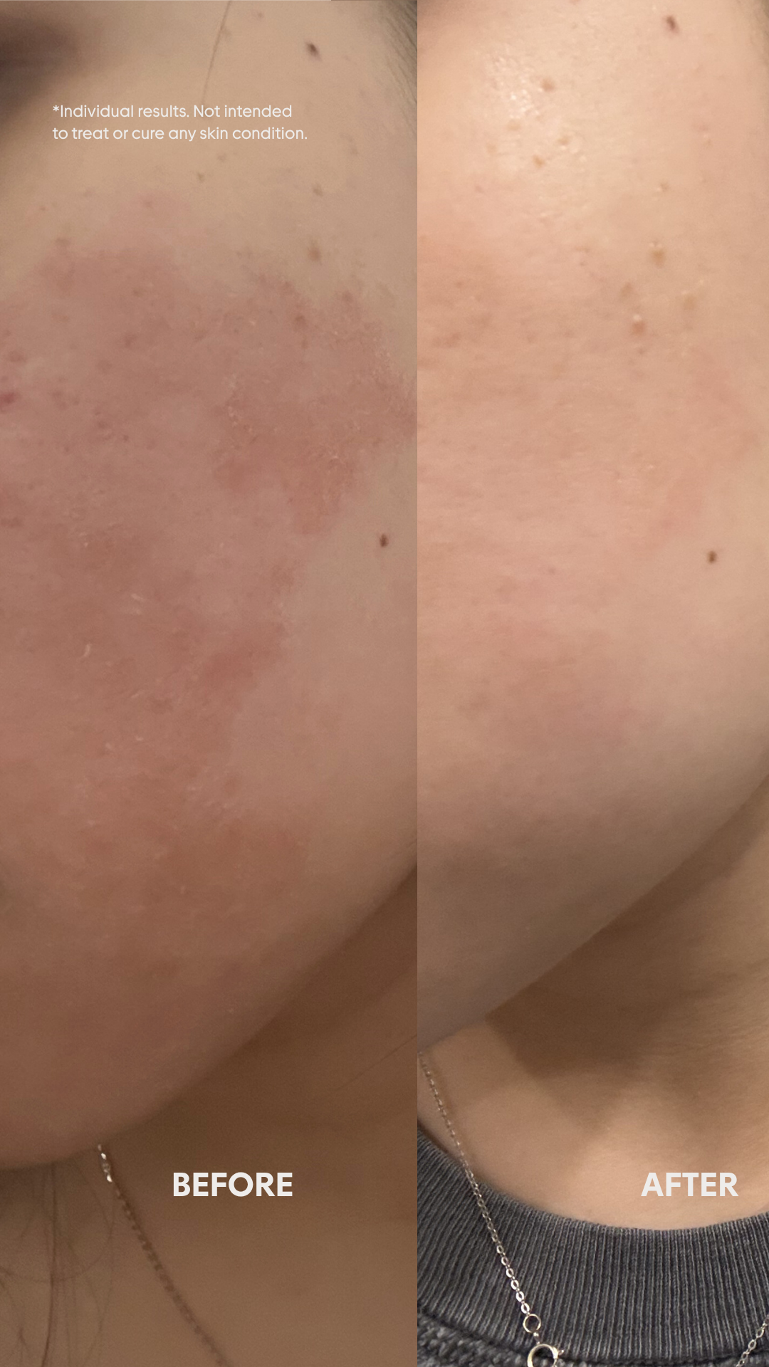 before and after close up of red dry flaky skin on face improving with Irritated serum